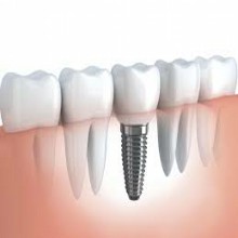 Náhrada jednoho zubu pomocí implantátu